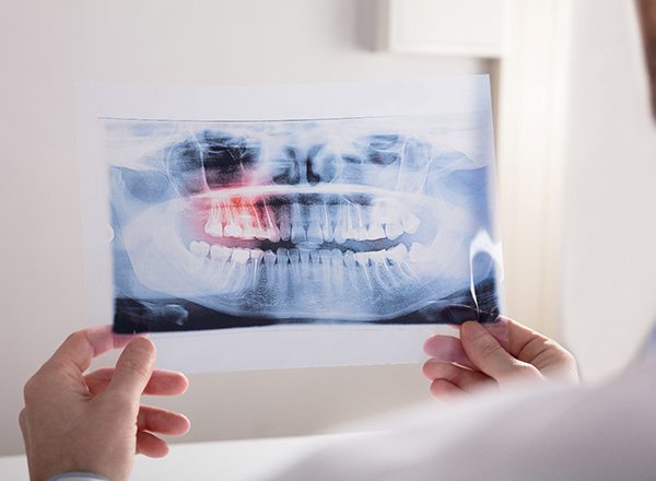 X-ray highlighting molars in red